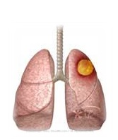 ตอนที่107 : กายภาพบำบัดในผู้ป่วยที่มีฝีในปอด ( Lung abscess )
