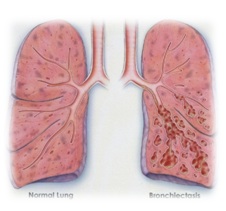 ตอนที่109 : กายภาพบำบัดในผู้ป่วยหลอดลมโป่งพอง ( bronchiectasis)