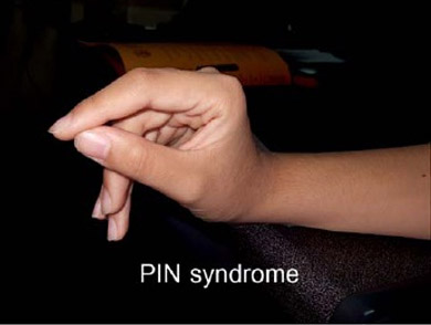 PIN Syndrome