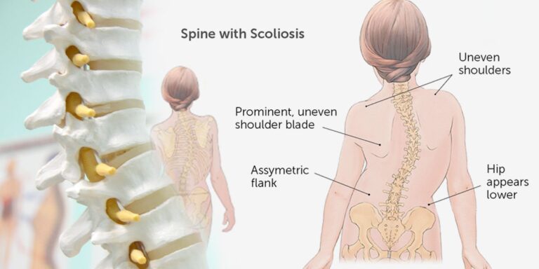 spine-colloisis-banner-1200x600